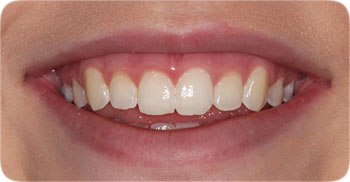 Kor Deep Bleachihng Cosmetic Dentistry Charlotte NC