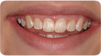 Kor Deep Bleachihng Cosmetic Dentistry Charlotte NC