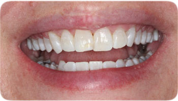 Kor Deep Bleachihng Cosmetic Dentistry Charlotte NC