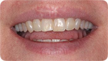 Kor Deep Bleachihng Cosmetic Dentistry Charlotte NC