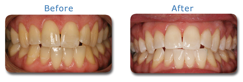Kor Deep Bleaching Cosmetic Dentistry Charlotte NC