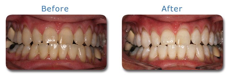 Kor Deep Bleaching Cosmetic Dentistry Charlotte NC