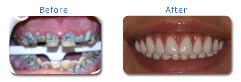 Cosmetic Dentist Dr. Brian McMurtry Full-mouth reconstruction