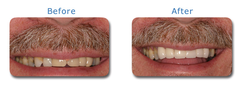 Cosmetic Dentistry Charlotte New crowns