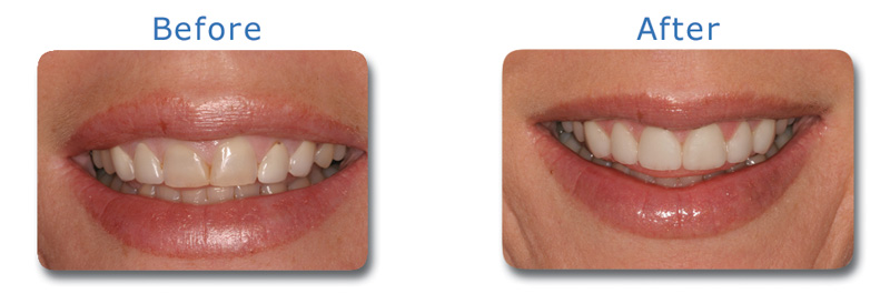 new veneers